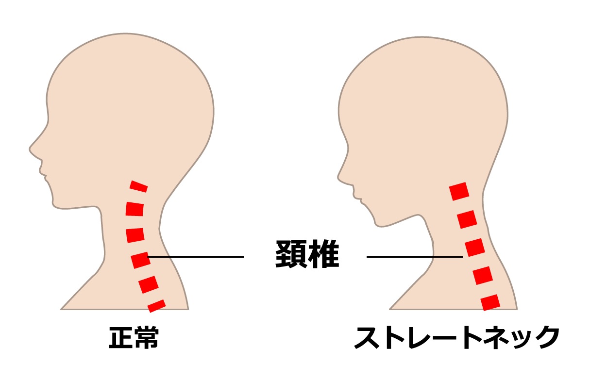 ストレートネックのイメージ